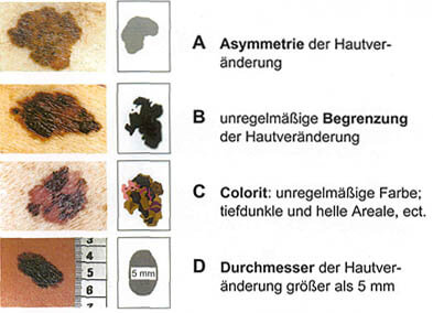 UniversitätsKlinikum Heidelberg: Hautkrebsscreening