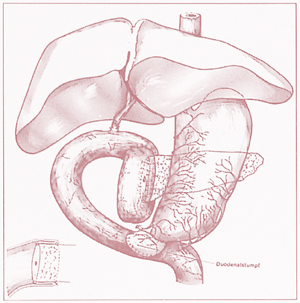 Whipple procedure to preserve