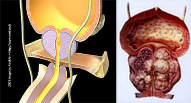 Universitatsklinikum Heidelberg Gutartige Prostatavergrosserung